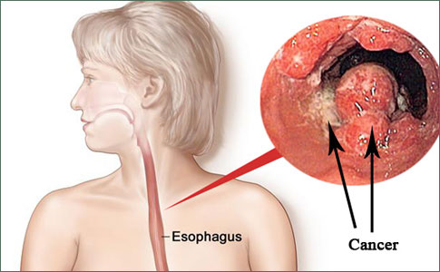 Esophageal Cancer - LAKESHORE CANCER CENTER
