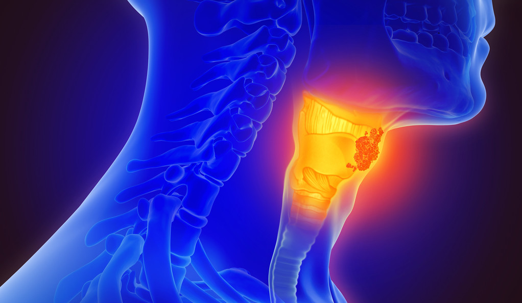 Head and Neck Tumor LAKESHORE CANCER CENTER