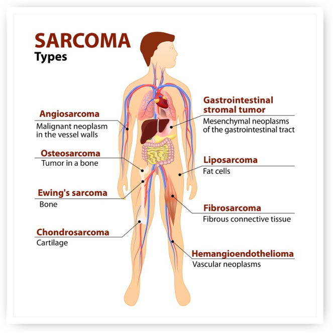 cancer pleomorphic sarcoma giardien mensch therapie